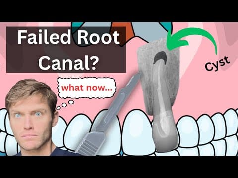 Surgical Removal of Cyst by Apicoectomy in Anterior Maxilla